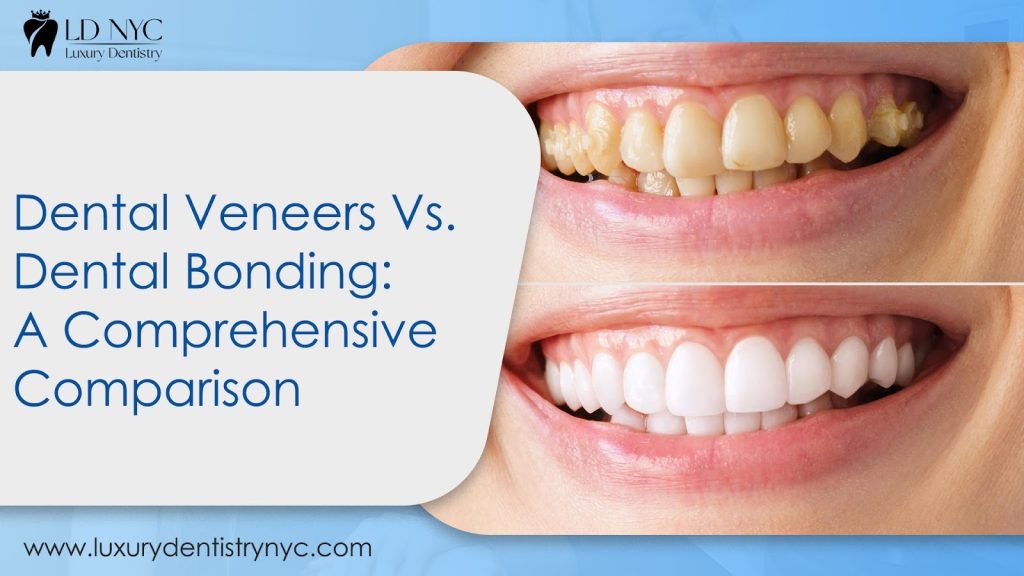 Dental Veneers Vs. Dental Bonding: A Comprehensive Comparison