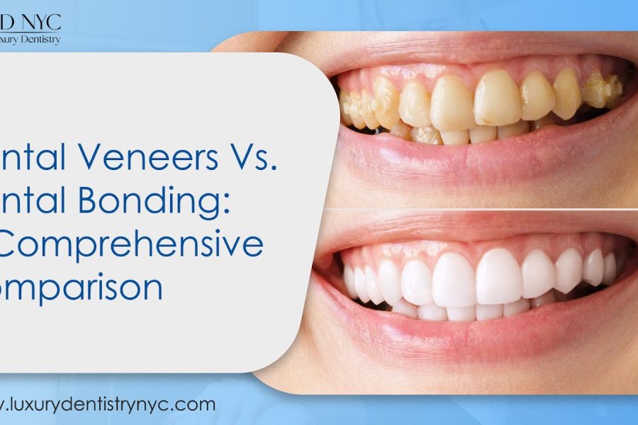Dental Veneers Vs. Dental Bonding: A Comprehensive Comparison