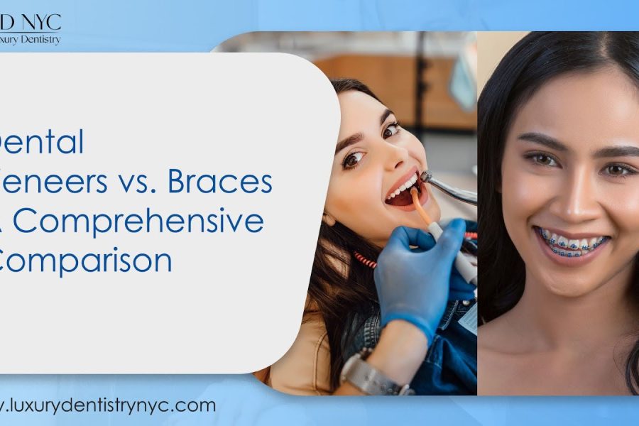 Dental veneers vs. braces: Which is better?