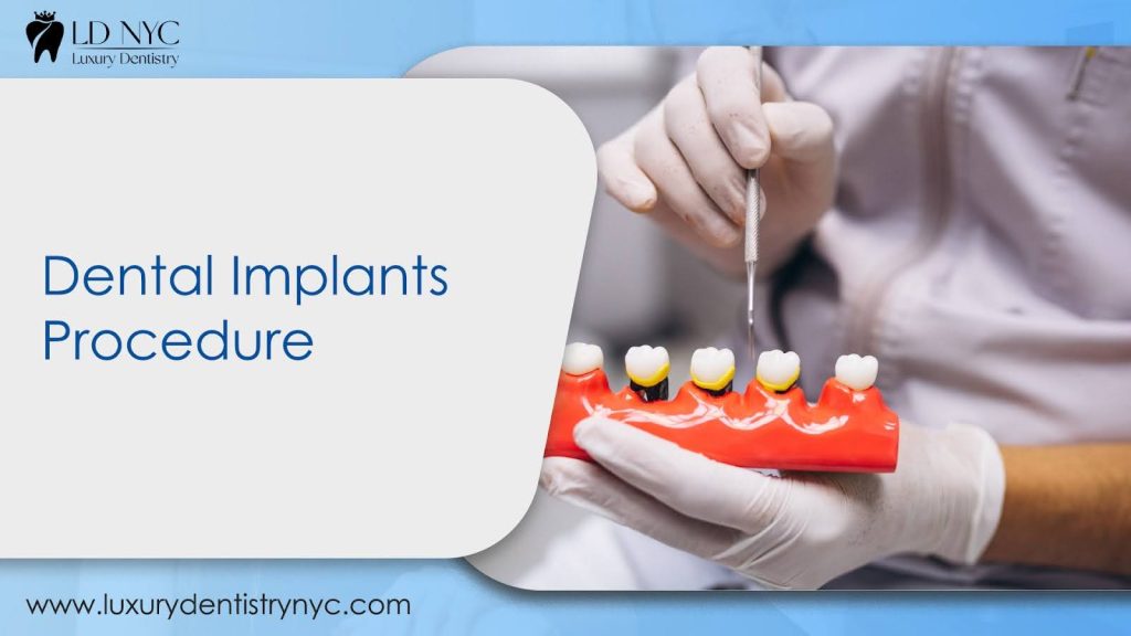 Dental Implants Procedure